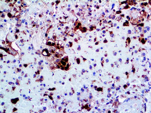 IHC of HSV II on an FFPE Infected Tissue